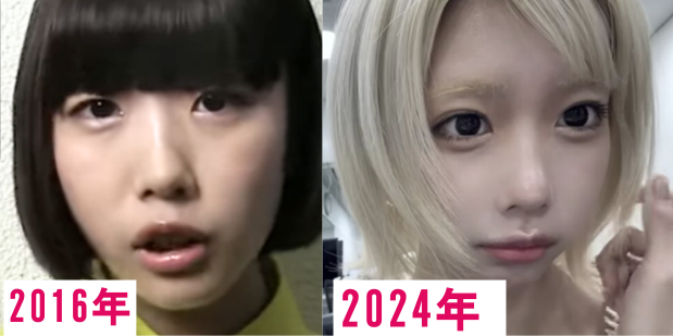 あのちゃん鼻の整形疑惑2016年と2024年。目鼻立ちがくっきりして顔の変化がわかる画像